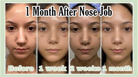 This should get better over time. . Hit my nose 1 month after rhinoplasty